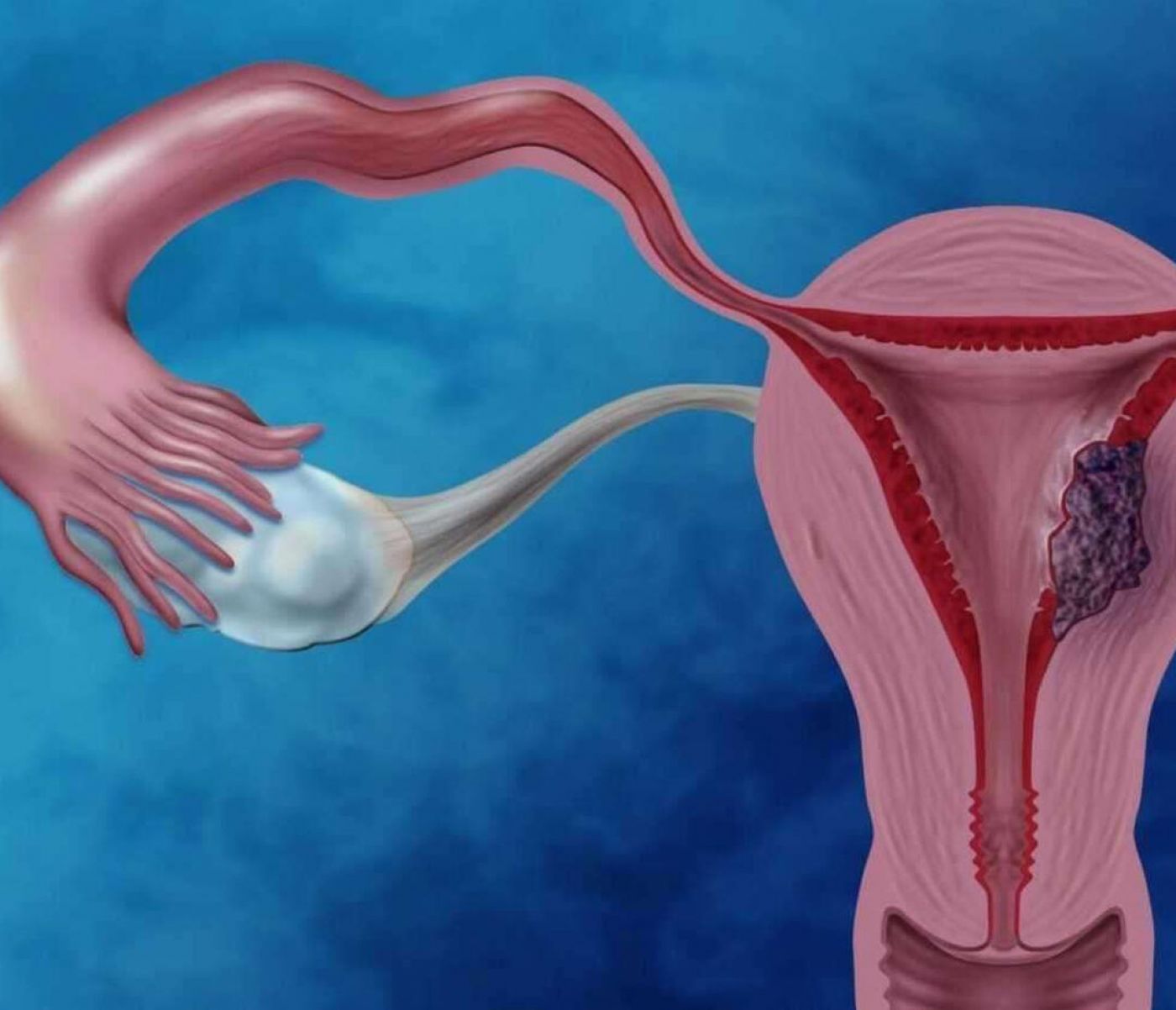 Ορώδης καρκίνος του ενδομητρίου: οι εξελίξεις που εγγυώνται καλύτερα αποτελέσματα